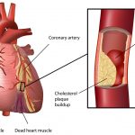 damaged heart caused by cholesterol