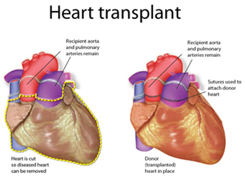 how heart transplantation is conducted