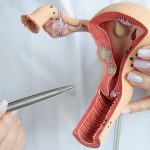 5 Things You Need to Know About Fibroids & Ovarian Cysts