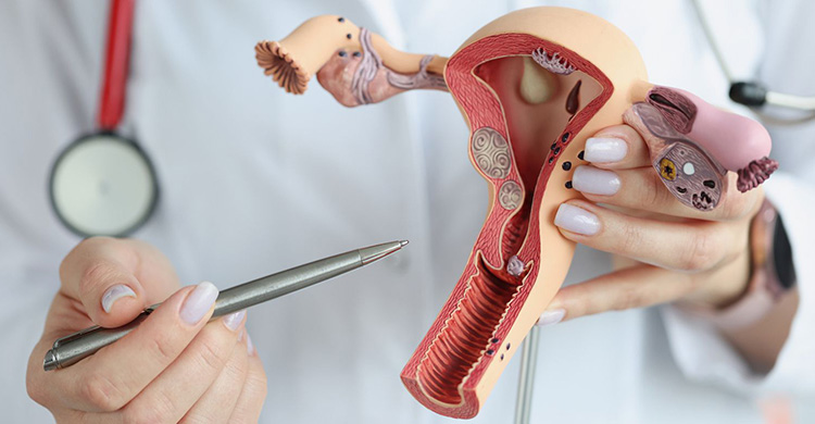 5 Things You Need to Know About Fibroids & Ovarian Cysts